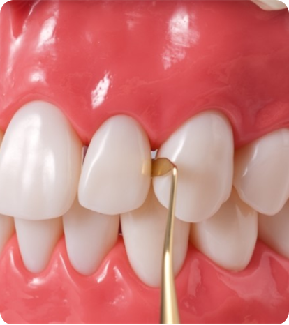 심미 레진 / 지르코니아