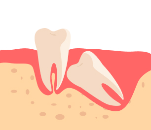 매복되어 있는 형태