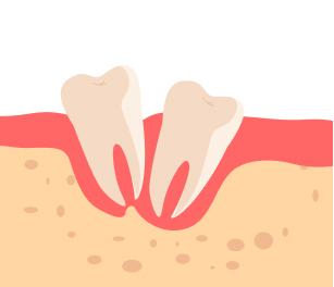 뿌리가 휘어 있는 경우