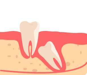 신경관, 상악동과 가까운 경우