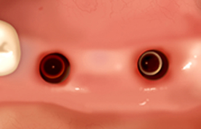 최소 절개를 통한 전문의의 절대적인 실력